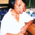agent-orange-deformities-vietnam
