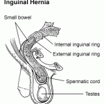 Inguinal hernia