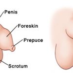 Phimosis Phimosis