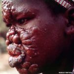 Leprosy Leprosy