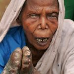 Leprosy - shortened fingers Leprosy - shortened fingers