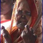 Leprosy - Shortened Fingers 2 Leprosy - Shortened Fingers 2