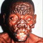Leprosy - face nodules Leprosy - face nodules