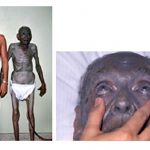 Argyria