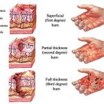 burn-classification burn-classification